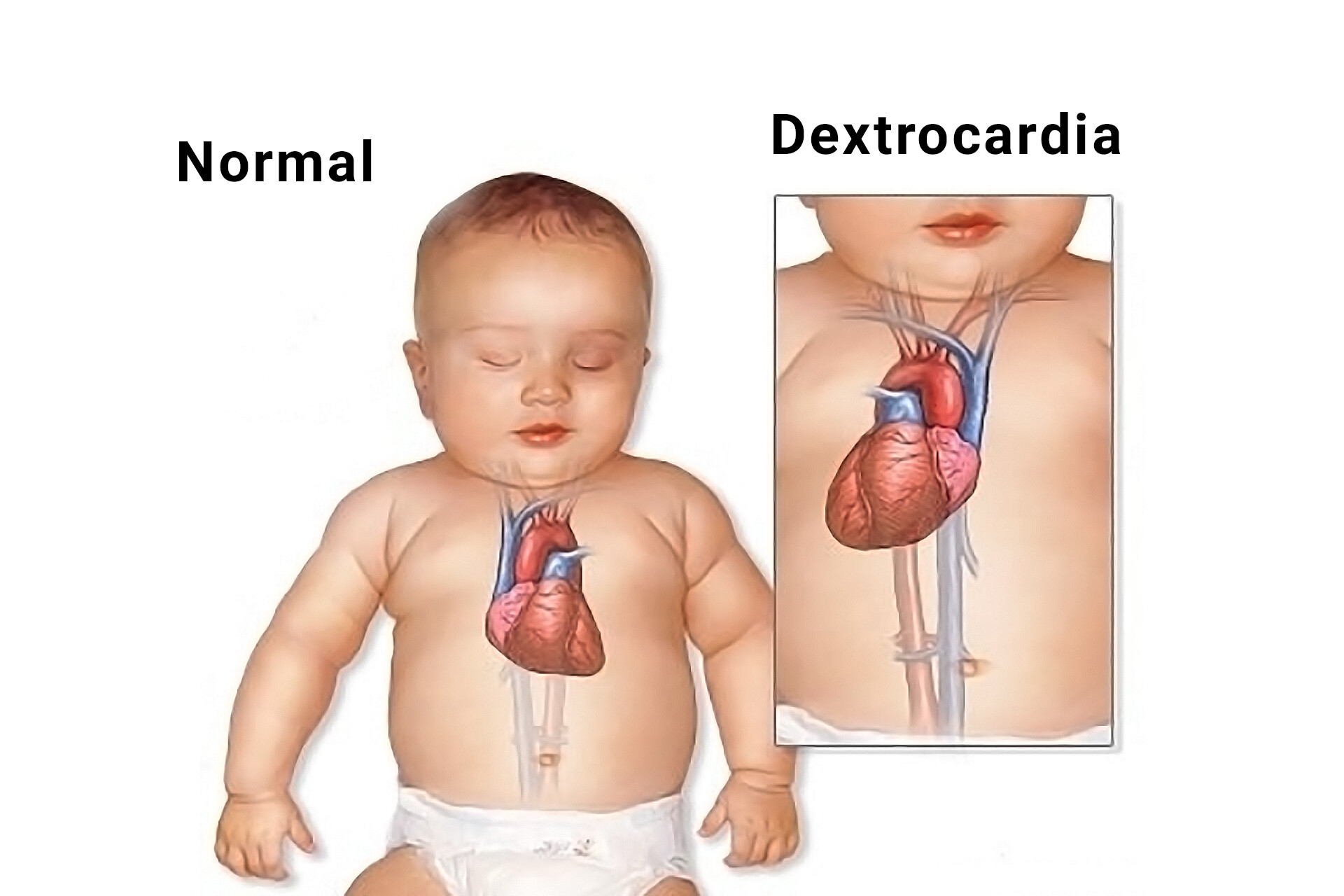 Dextrocardia-with-Situs-Inversus