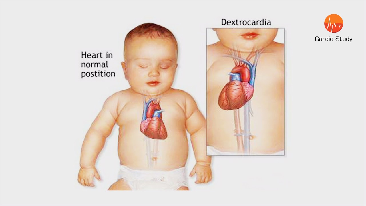 Dextrocardia-–-Cardio-Study