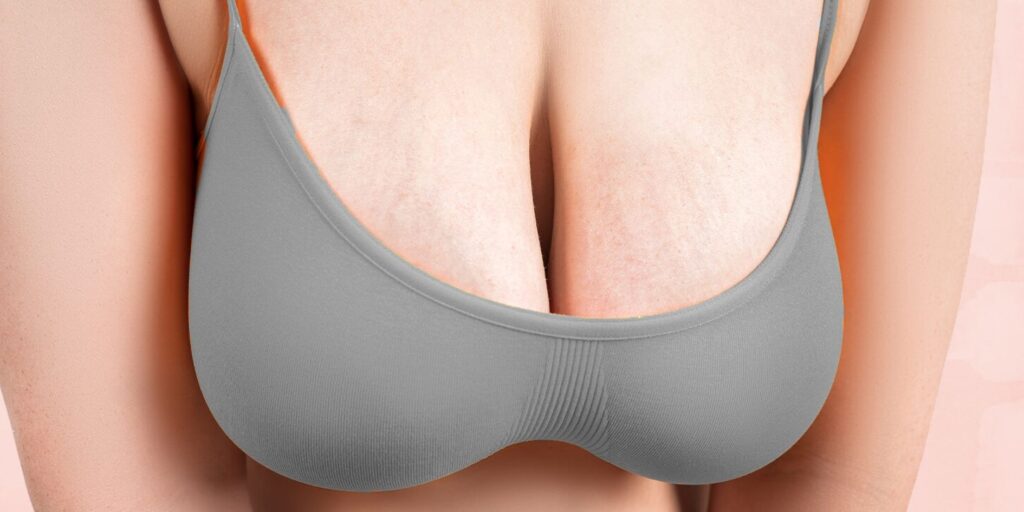 Breast Sagging